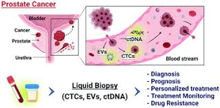 Image result for Prostate Cancer Management