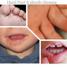 The infection is not related to foot and mouth disease, which affects cattle, sheep and pigs. Hand Foot And Mouth Disease Hfmd Olasmile