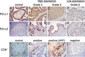 52 269 tykkäystä · 11 304 puhuu tästä. Programmed Cell Death 1 Ligand 1 And Tumor Infiltrating Cd8 T Lymphocytes Are Prognostic Factors Of Human Ovarian Cancer Pnas
