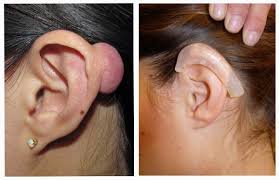 Ear Surgery Is Also Called Otoplasty Or Ear Pinning This External Ear Surgery Is Usually Performed To Reduce Ear Prominence B Cauliflower Ear Skin Scar Tissue