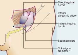 In female, groin is just above the top of the leg, between the lowest part of the tummy and the top of the thigh. Inguinal Hernia Anatomy Female Anatomy Drawing Diagram