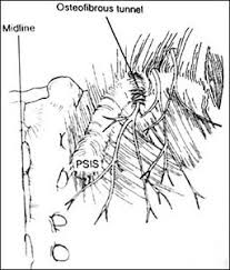 Maybe you would like to learn more about one of these? Low Back Pain Cluneal Nerve Entrapment Stemcelldoc S Weblog