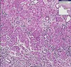 Herpes esophagitis (he), caused by herpes simplex virus (hsv), is a common opportunistic infection in the immunocompromised or severely ill host, 7,33 particularly in patients with human immunodeficiency virus (hiv) infection, underlying malignancy, burns, organ transplantation, immunosuppressive therapy, or systemic corticosteroids. Histopathology Esophagus Herpes Esophagitis Youtube