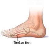 Image result for what is treatment for broken bones in the top of the foot
