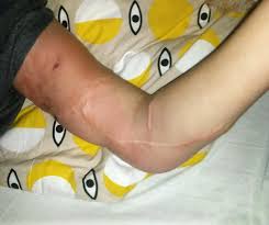 Image result for erysipel photos)