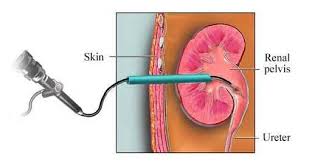 Percutaneous Nephrolithotomy Or Pcnl Is A Method For Evacuating Medium Sized Or Bigger Renal Calculi Kidney Stones Fr Renal Calculi Kolkata Vein Thrombosis
