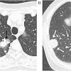 In fact, is the only sign present in 7% to 35% of people at the time of diagnosis. 1