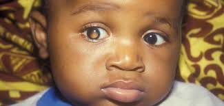 Symptoms of eye cancer eye cancer does not always cause obvious symptoms and may only be picked up during a routine eye test. Retinoblastoma The Canadian Association Of Optometrists