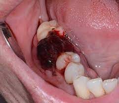Use them in commercial designs under lifetime, perpetual & worldwide rights. What Does The Wisdom Tooth Blood Clot Look Like Novocom Top
