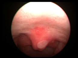 Check spelling or type a new query. Throat Pain Due To Ulcer Uvula Youtube