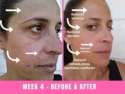 To revisit this article, visit my profile, thenview saved stories. Project E Beauty Led Face Mask Before And After 30 Days