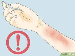 Oder ist das gifteiche?, gegen die ich eine zeichnung getauscht habe; Ausschlag Von Giftefeu Oder Gifteiche Behandeln Wikihow