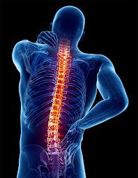 Image result for Spinal Epidural Abscess