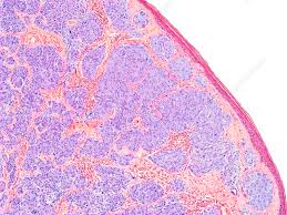 Image result for Spitz Nevus