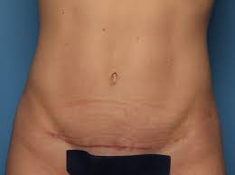 A tummy tuck is a transformation that is hard to grasp. Before And After Mini Tummy Tuck Photos