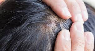 Scalp Acne Scalp Acne Scalp Acne Treatment Scalp Psoriasis