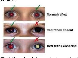 Image result for Red Reflex