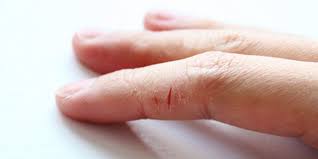 Cara mencegah kulit kering pada tangan. Kulit Kering Di Tangan Retak Penyebab Utama Kulit Kering Dan Merekah Di Tangan Kaedah Rawatan