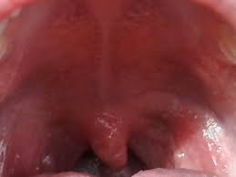 And, he has a blood blister on it as well. Palatine Uvula Wikidoc
