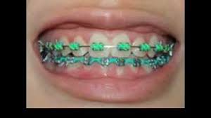 One of the most important questions you will ask yourself is how long the braces take to straighten your teeth. When Will My Braces Start Showing Results Orthodontic Associates