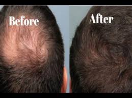 The truth about coconut oil for hair growth and health may surprise you! How To Grow Your Hair With Garlic And Coconut Oil Stop Hair Fall Home Remedies Youtube