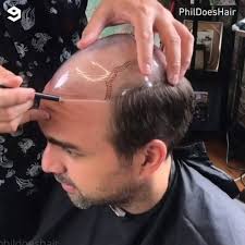 Hair replacement transformation