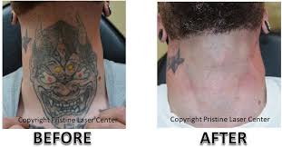 The length of time and number of treatments it takes to break up a tattoo depends on how many pigments are in there — and that adds onto the total cost. Before And After Laser Tattoo Removal Orlando Pristine Laser Center Pristine Laser Center Orlando