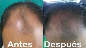 Como Recuperar Mi Cabello Perdido Youtube