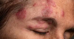 Image result for shingles