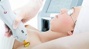 The laser halts all hair follicle growth, leading to the shedding of the hair in the week following treatment. Laser Hair Removal Laser Hair Removal Phoenix Senza Pelo