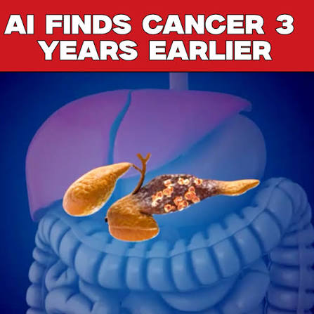 Researchers at Mayo Clinic have developed a new artificial intelligence (AI) system that could help doctors detect pancreatic cancer up to three years earlier than it is usually diagnosed, giving patients a