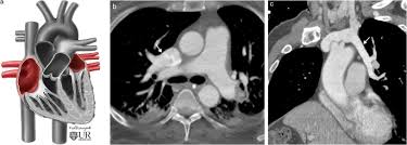 Pictorial Review Of The Pulmonary Vasculature From Arteries To Veins Insights Into Imaging Full Text