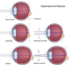 Image result for Refractive Error