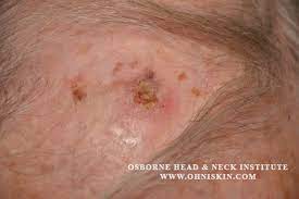 It is marked by red, irritated, greasy, and oily skin covered with flaky white or yellow scales. Squamous Cell Carcinoma Reconstruction Of The Scalp