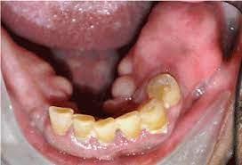 Osteosarcoma of the jaw ✅. Low Grade Central Osteosarcoma Of The Mandible Clinically Mimicking A Benign Fibro Osseous Lesion A Rare Case Report