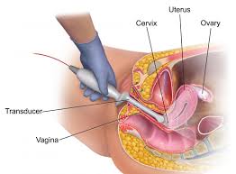 Pemeriksaan Usg Transvaginal Vs Usg Abdominal Lebih Baik Mana