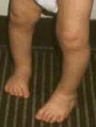 إنحراف القدم للداخل عند الأطفال اثناء المشي intoeing gait الدكتور مازن كردية