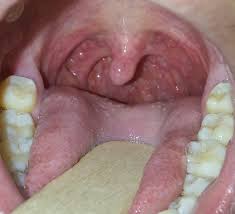 Your child will likely be better within seven to 10 days. Tonsils When To Worry