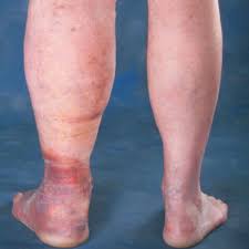 We all know a birthmark is skin discoloration either present at birth or appearing within the first month of a baby's life. 5 Stages Of Vein Disease That Need To Be Taken Seriously