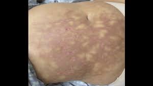 The baby's navel area shouldn't be submerged in water during bathing until this occurs. Mottled Skin Causes Symptoms Pictures Treatment And More