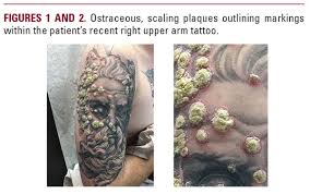 Image result for koebner phenomenon psoriasis