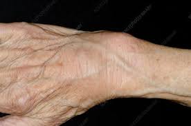 It's commonly done by health professionals such as sports physicians, physiotherapists, podiatrists and chiropractors, but it can be easily learned at home as well. Swollen Sprained Wrist Stock Image C013 5897 Science Photo Library