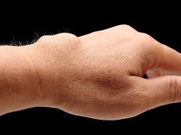 Lastig Aber Harmlos Das Handgelenks Ganglion Uberbein