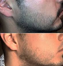 Is rogaine/minoxidil effective for beard growth? Does Rogaine Work For Hairline Vertex Thinning Women Beards