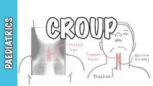Image result for Croup