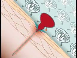 Severe reactions can cause difficulty breathing, coma, and death. How Does A Jellyfish Sting Youtube