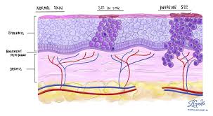 Uv light exposure has been described as a developmental factor in people and appears to be associated with the development in cats. Squamous Cell Carcinoma Of The Skin Mypathologyreport Ca