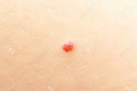 Cherry angiomas, the most common vascular proliferation in the skin, are usually found on the trunk and limbs and less frequently on the face and scalp. Cherry Angioma Or Campbell De Morgan Spots Stock Photo Picture And Royalty Free Image Image 62127899