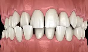 How long do braces take to straighten your teeth? What Are Crowded Teeth Causes Treatment Options