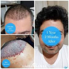 4000 Grafts 1 Year 2 Months Perfect Result Of Our After The Hair Transplantation Hair Transplant Hair Transplant Procedure Grafting